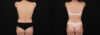 Tummy Tuck case #7776 slider thumbnail
