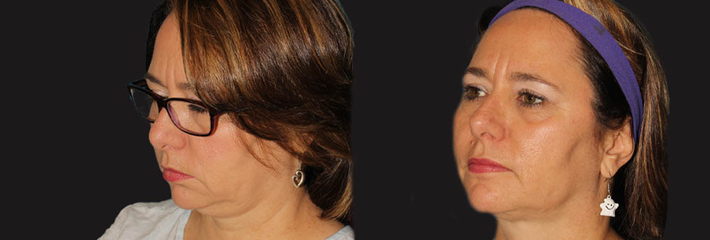 Submental Liposuction case #6945