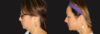 Submental Liposuction case #6945 slider thumbnail