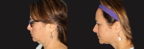Submental Liposuction case #6945