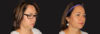 Submental Liposuction case #6945 slider thumbnail