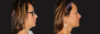 Submental Liposuction case #6945 slider thumbnail