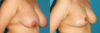Breast Reduction case #7950 slider thumbnail