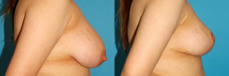 Breast Reduction case #7950