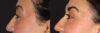 Blepharoplasty case #6888 slider thumbnail