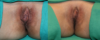 Labiaplasty case #5801 slider thumbnail