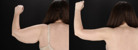 Arm Lift case #4384