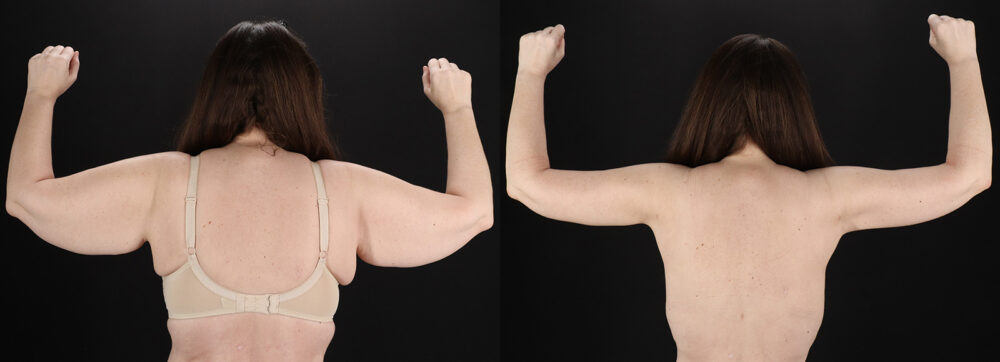 Arm Lift case #4384