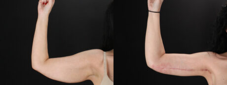 Arm Lift case #4393