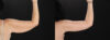 Arm Lift case #4393 slider thumbnail