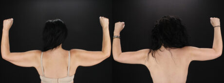 Arm Lift case #4393