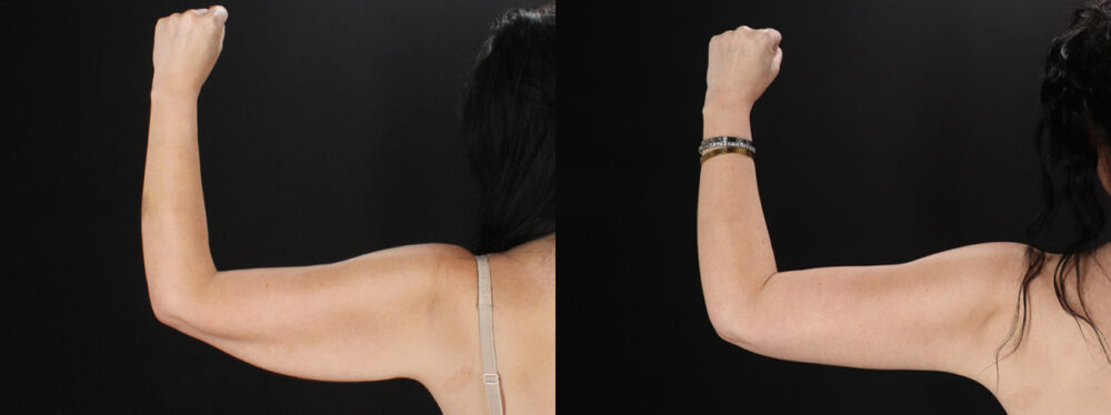 Arm Lift case #4393