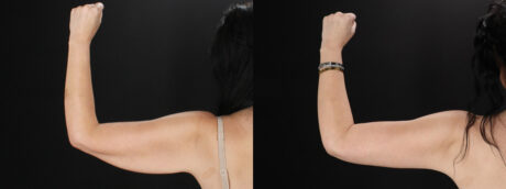 Arm Lift case #4393