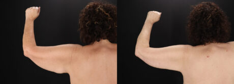 Arm Lift case #4400