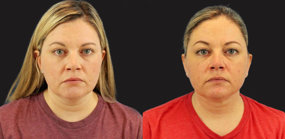 Submental Liposuction case #6944