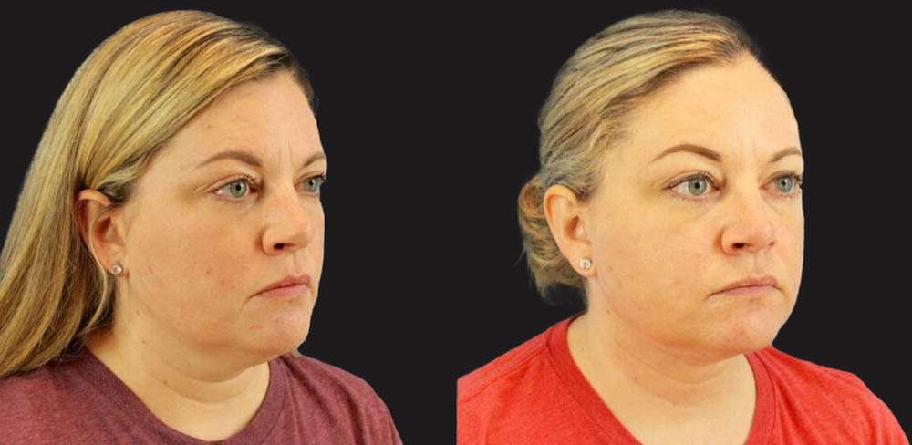 Submental Liposuction case #6944