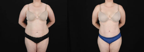 Tummy Tuck case #256538