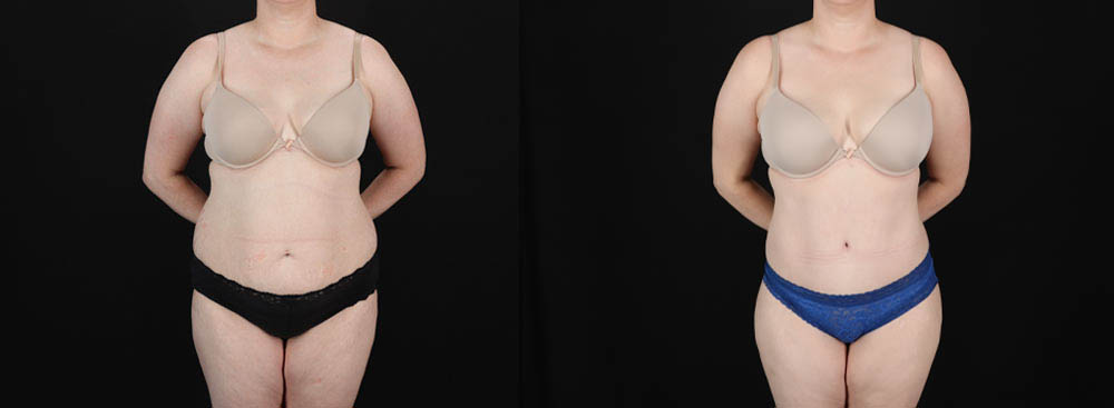 Tummy Tuck case #256538