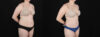 Tummy Tuck case #256538 slider thumbnail