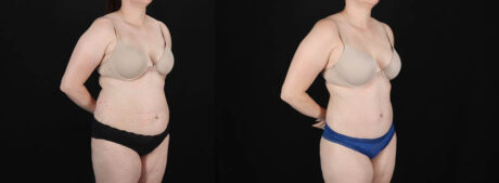 Tummy Tuck case #256538