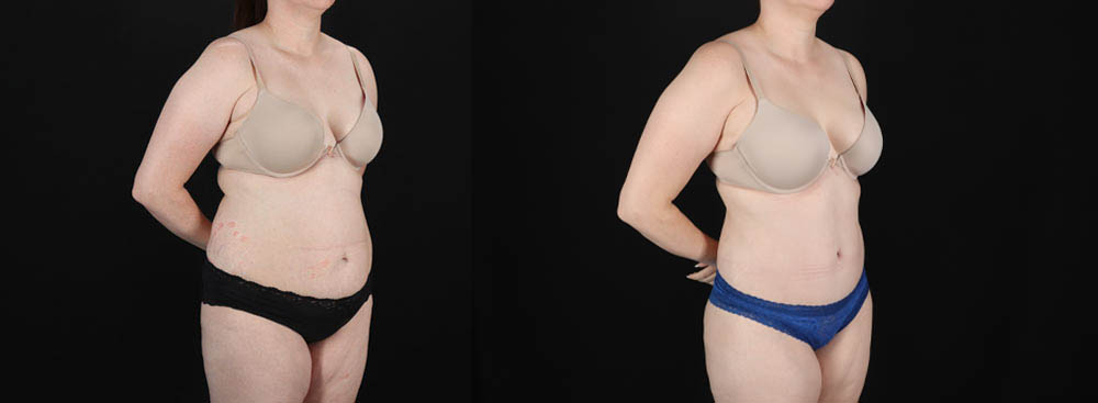 Tummy Tuck case #256538