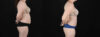 Tummy Tuck case #256538 slider thumbnail