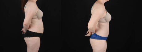 Tummy Tuck case #256538