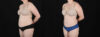 Tummy Tuck case #256538 slider thumbnail