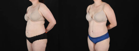 Tummy Tuck case #256538