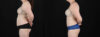 Tummy Tuck case #256538 slider thumbnail