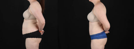 Tummy Tuck case #256538