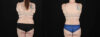 Tummy Tuck case #256538 slider thumbnail