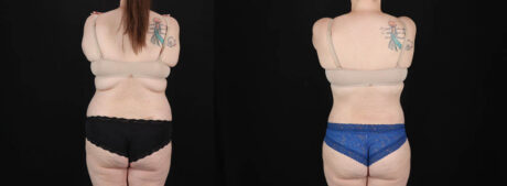 Tummy Tuck case #256538