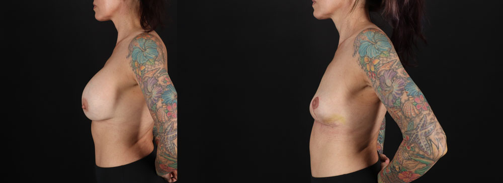 Implant Removal case #256480