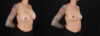 Implant Removal case #256480 slider thumbnail