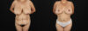 Post Bariatric Surgery (Massive Weight Loss) case #256488 slider thumbnail