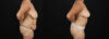 Post Bariatric Surgery (Massive Weight Loss) case #256488 slider thumbnail