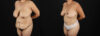 Post Bariatric Surgery (Massive Weight Loss) case #256488 slider thumbnail