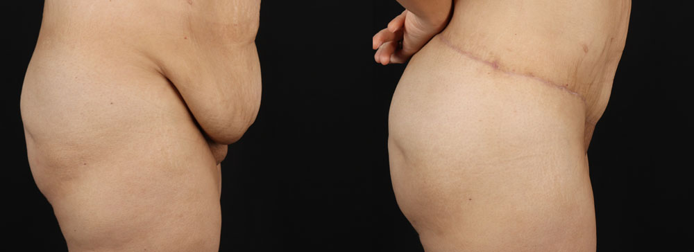 Post Bariatric Surgery (Massive Weight Loss) case #256488