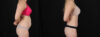 Tummy Tuck case #256517 slider thumbnail