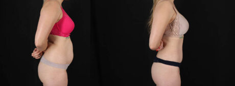 Tummy Tuck case #256517