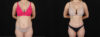 Tummy Tuck case #256517 slider thumbnail