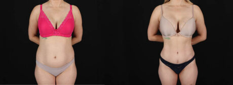 Tummy Tuck case #256517
