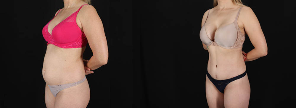 Tummy Tuck case #256517