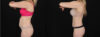 Tummy Tuck case #256517 slider thumbnail