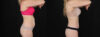 Tummy Tuck case #256517 slider thumbnail