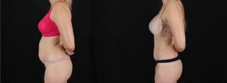 Tummy Tuck case #256517