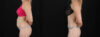 Tummy Tuck case #256517 slider thumbnail