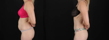 Tummy Tuck case #256517