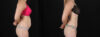 Tummy Tuck case #256517 slider thumbnail